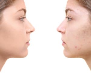 before and after of acne treatment